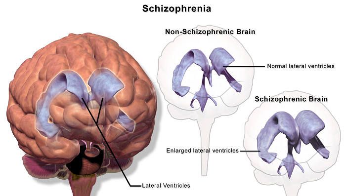 Шизофрения мозг