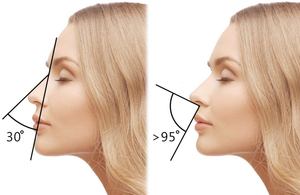 Идеальная форма носа