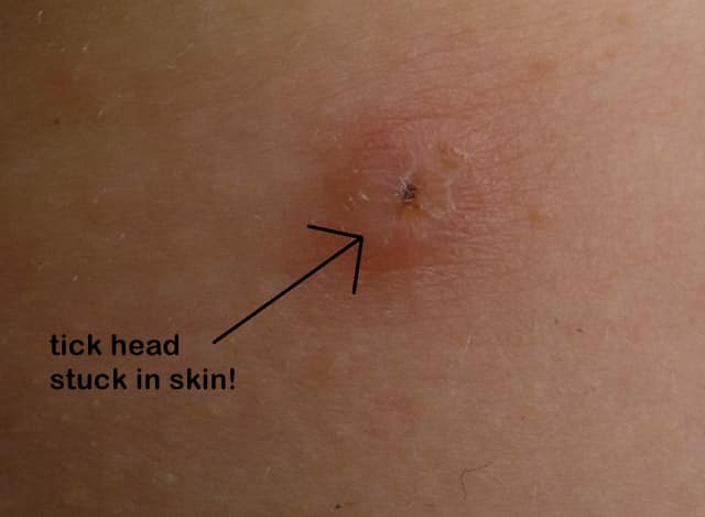 tick head stuck in skin