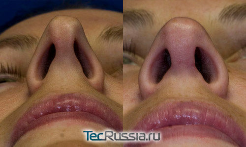 фото до и после коррекции асимметричных ноздрей